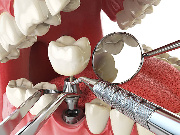 Best Emergency Treatment for Toothache in Palm Beach, FL